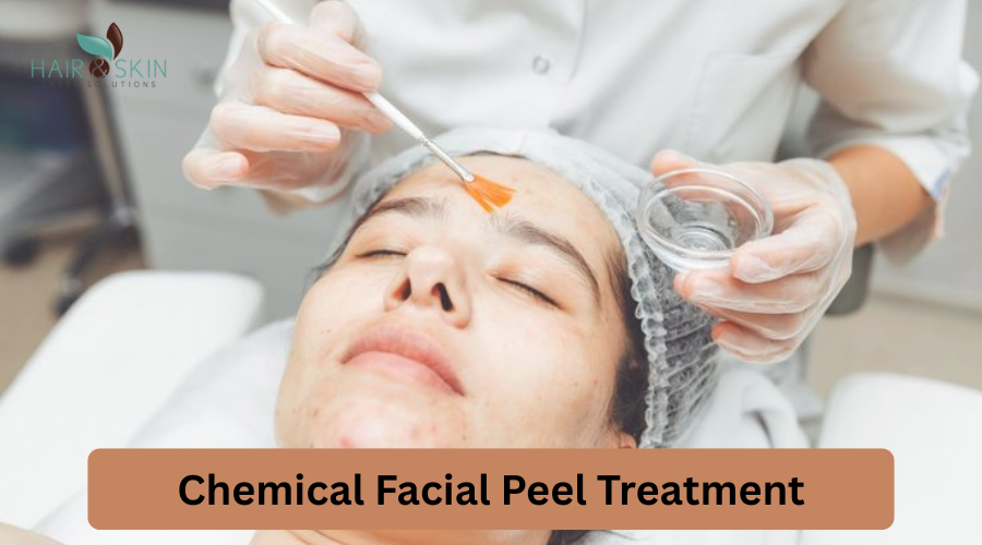 Chemical Facial Peel Treatment: Reveal Healthier, Brighter Skin